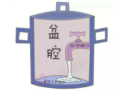 盆腔積液是怎麽回事？白帶免费深夜福利APP廠家提醒早了解早預防