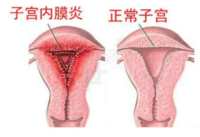 全自動陰道分泌物深夜福利影院廠家子宮內膜炎的症狀表現提前了解與預防