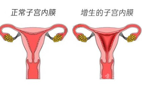 白帶常規深夜福利影院廠家解讀子宮內膜增生是什麽原因引起的