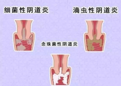 全自動陰道分泌物深夜福利影院廠家提醒您還在拖延嗎，還在等陰道炎自愈嗎？