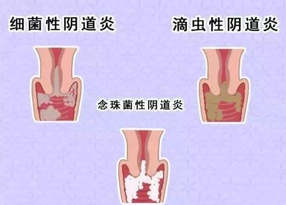 全自動陰道分泌物深夜福利影院廠家提醒您還在拖延嗎，還在等陰道炎自愈嗎？